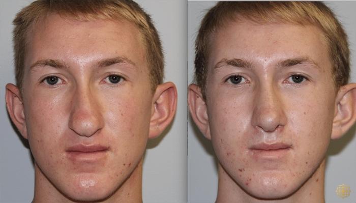 Before & After Rhinoplasty Case 133 Front View in Newport Beach, CA