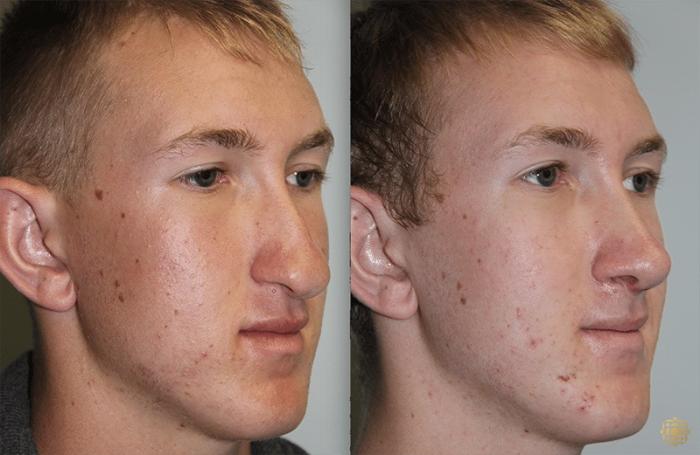 Before & After Rhinoplasty Case 133 Right Oblique View in Newport Beach, CA