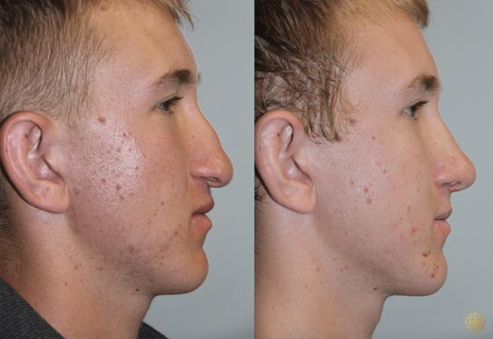 Before & After Rhinoplasty Case 133 Right Side View in Newport Beach, CA
