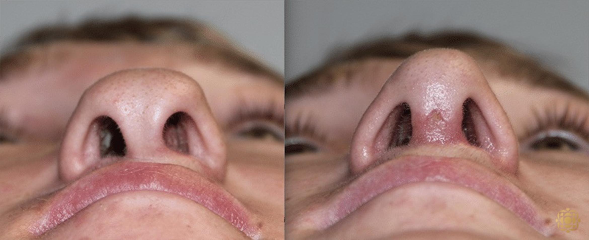 Before & After Rhinoplasty Case 133 Under View in Newport Beach, CA