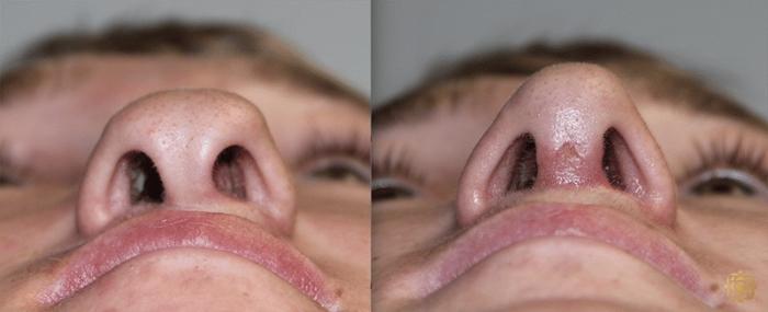 Before & After Rhinoplasty Case 133 Under View in Newport Beach, CA