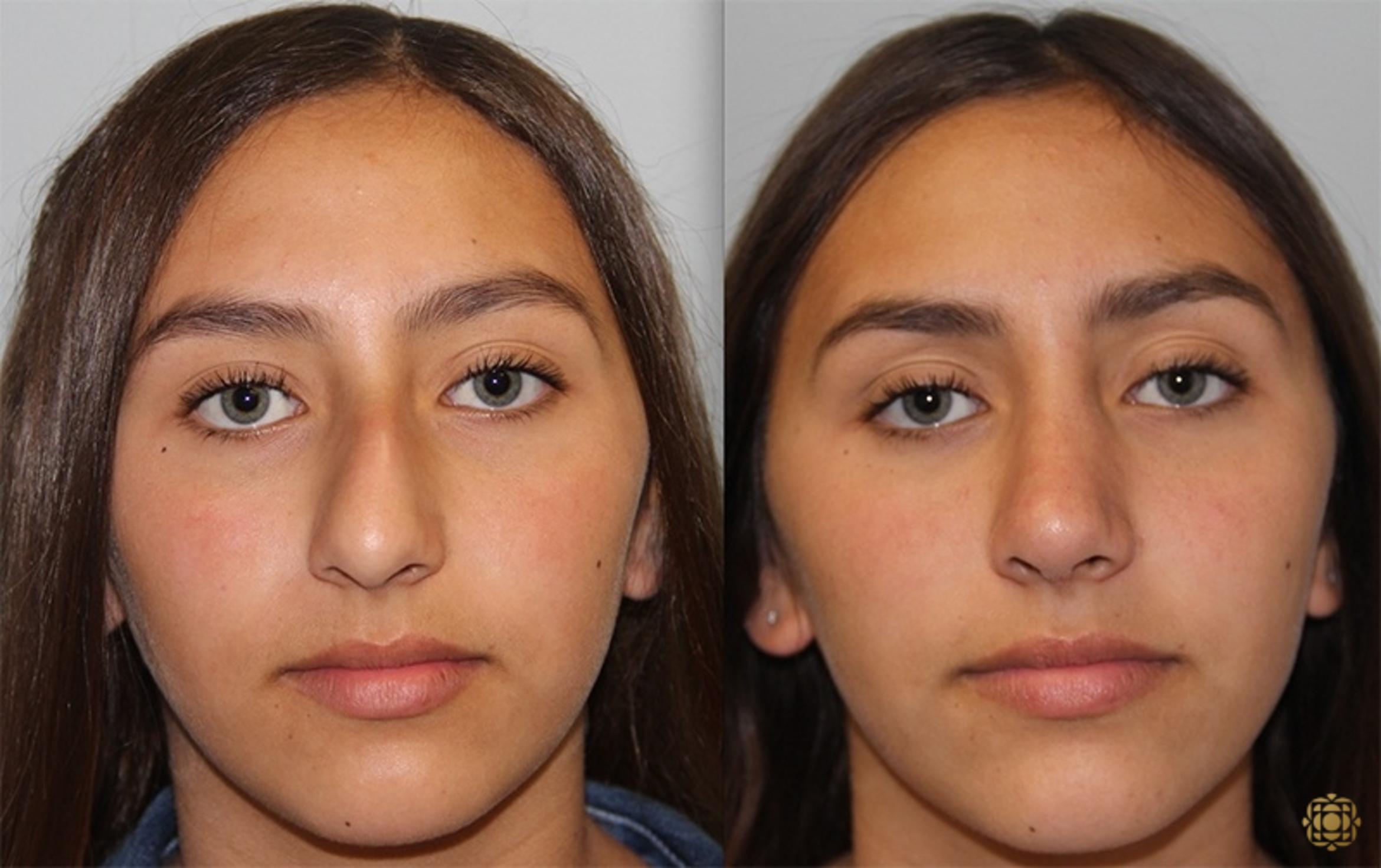 Before & After Rhinoplasty Case 137 Front View in Newport Beach, CA
