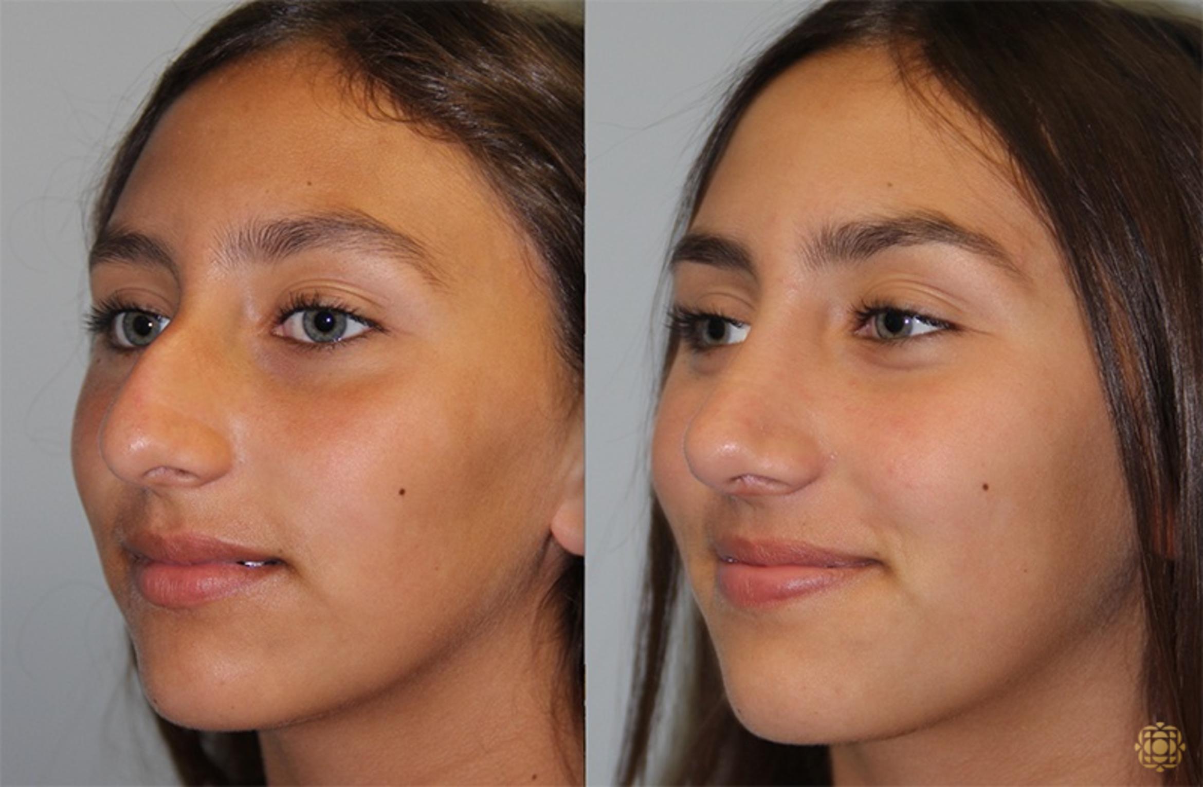 Before & After Rhinoplasty Case 137 Left Oblique View in Newport Beach, CA