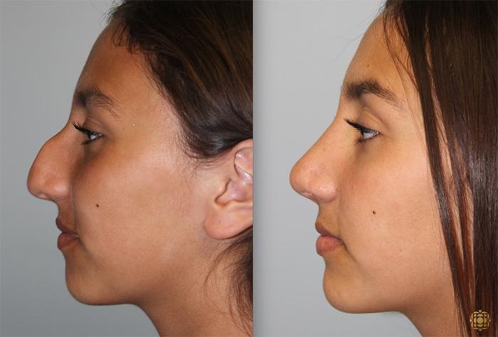 Before & After Rhinoplasty Case 137 Left Side View in Newport Beach, CA