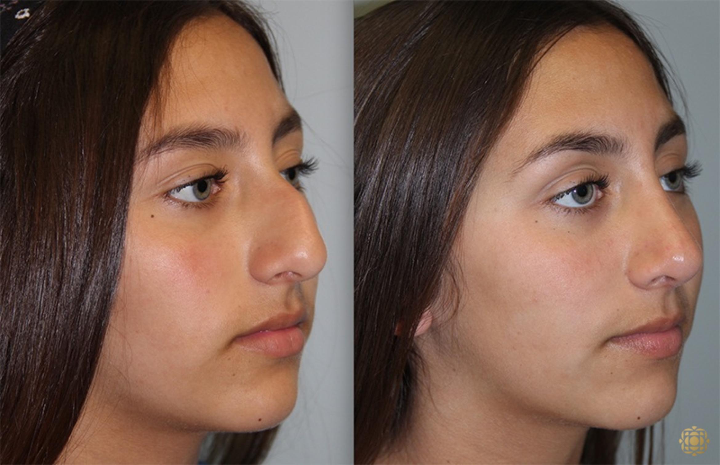 Before & After Rhinoplasty Case 137 Right Oblique View in Newport Beach, CA