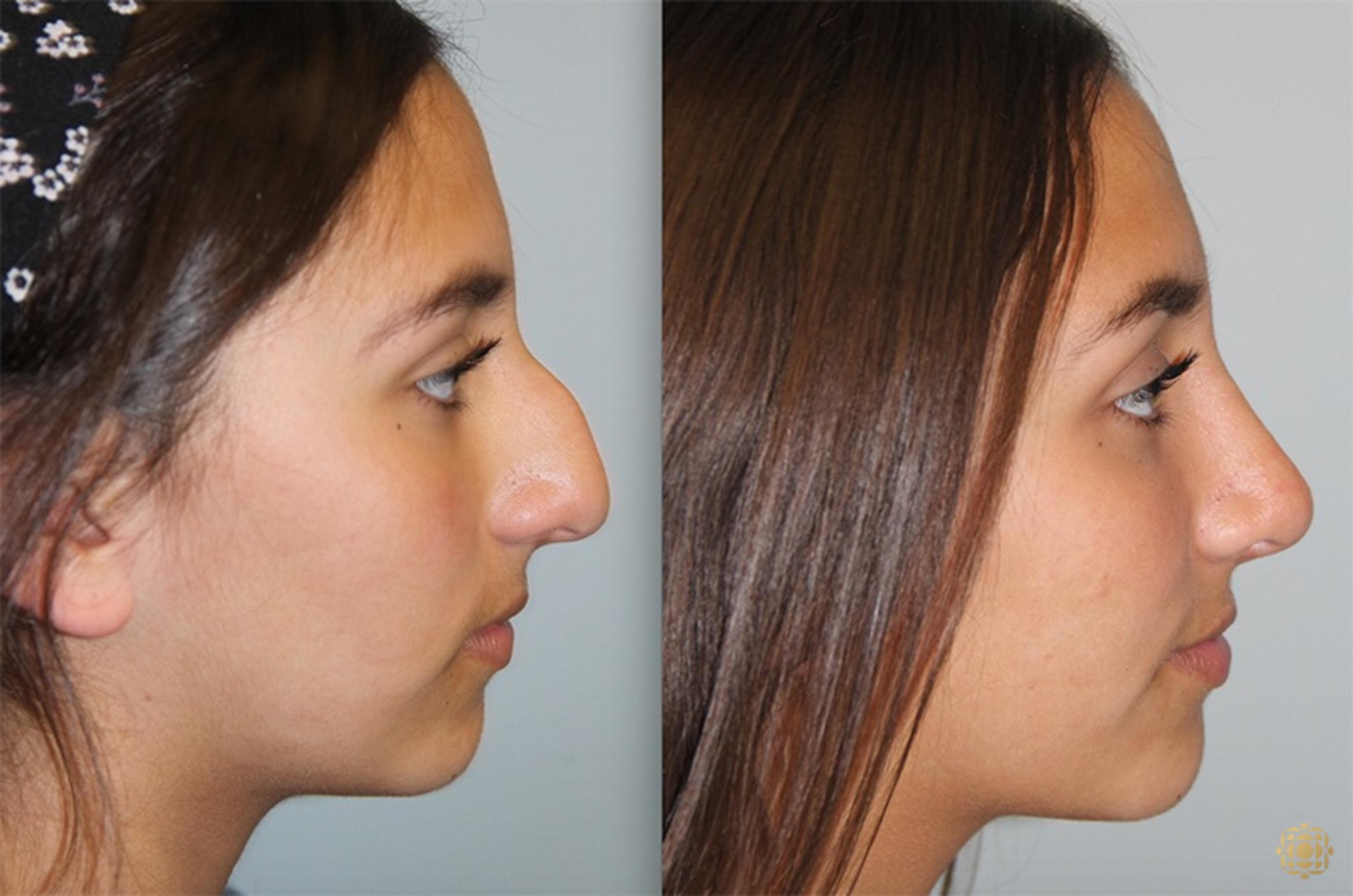 Before & After Rhinoplasty Case 137 Right Side View in Newport Beach, CA