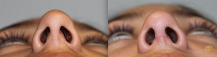 Before & After Rhinoplasty Case 137 Under View in Newport Beach, CA