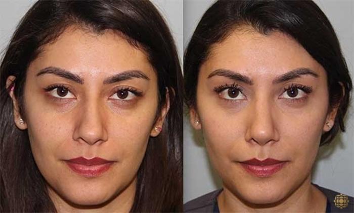 Before & After Rhinoplasty Case 143 Front View in Newport Beach, CA