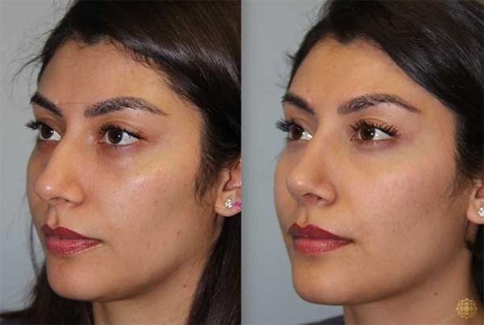 Before & After Rhinoplasty Case 143 Left Oblique View in Newport Beach, CA