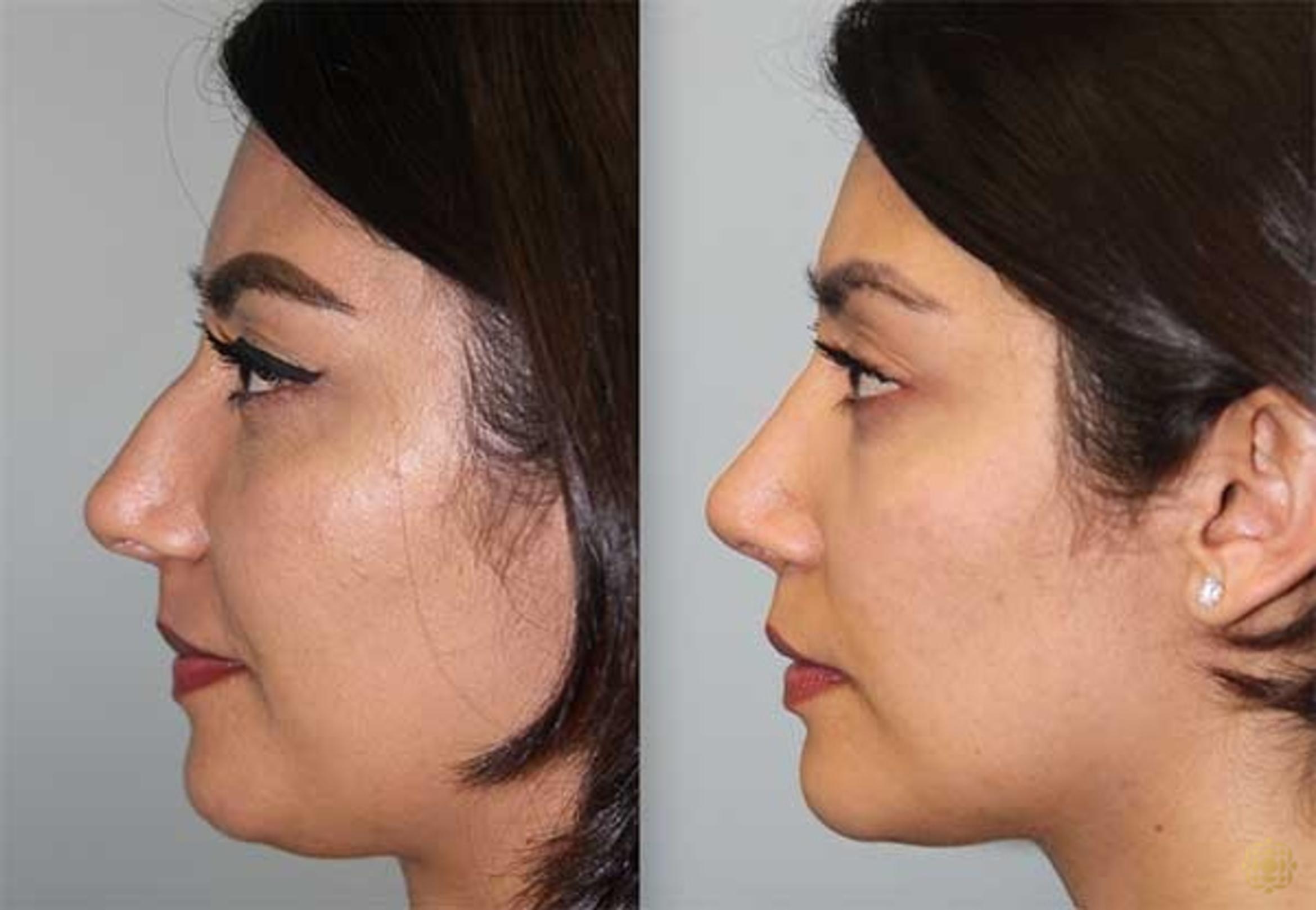 Before & After Rhinoplasty Case 143 Left Side View in Newport Beach, CA