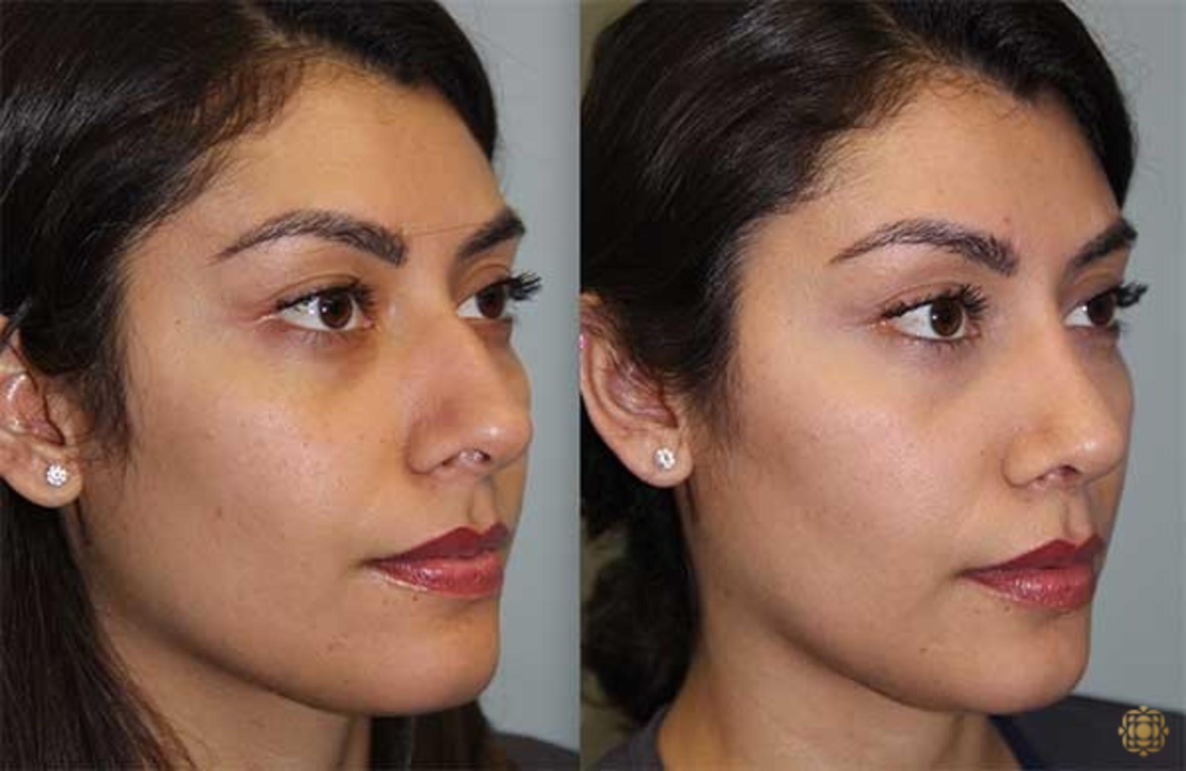 Before & After Rhinoplasty Case 143 Right Oblique View in Newport Beach, CA