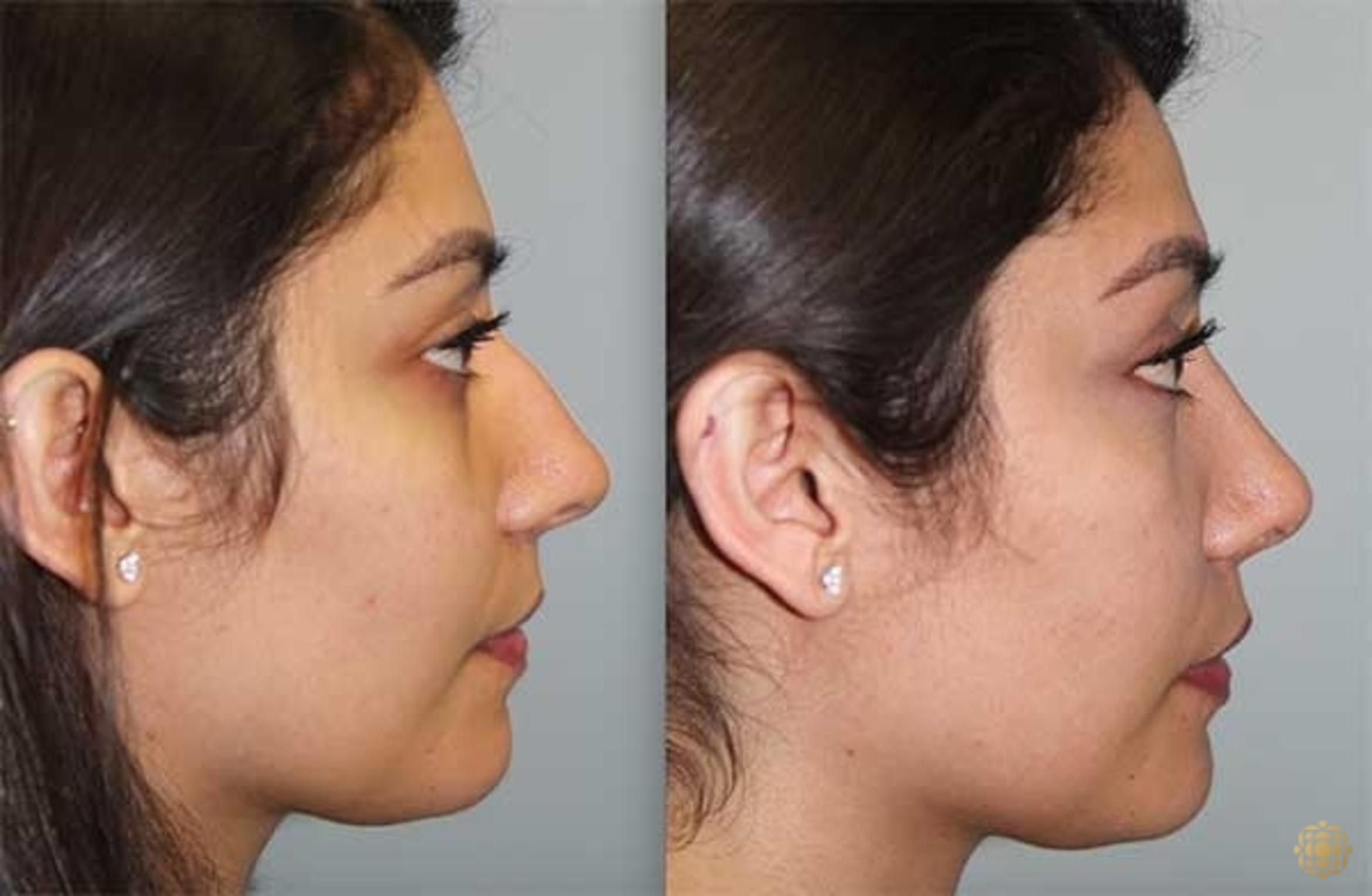Before & After Rhinoplasty Case 143 Right Side View in Newport Beach, CA