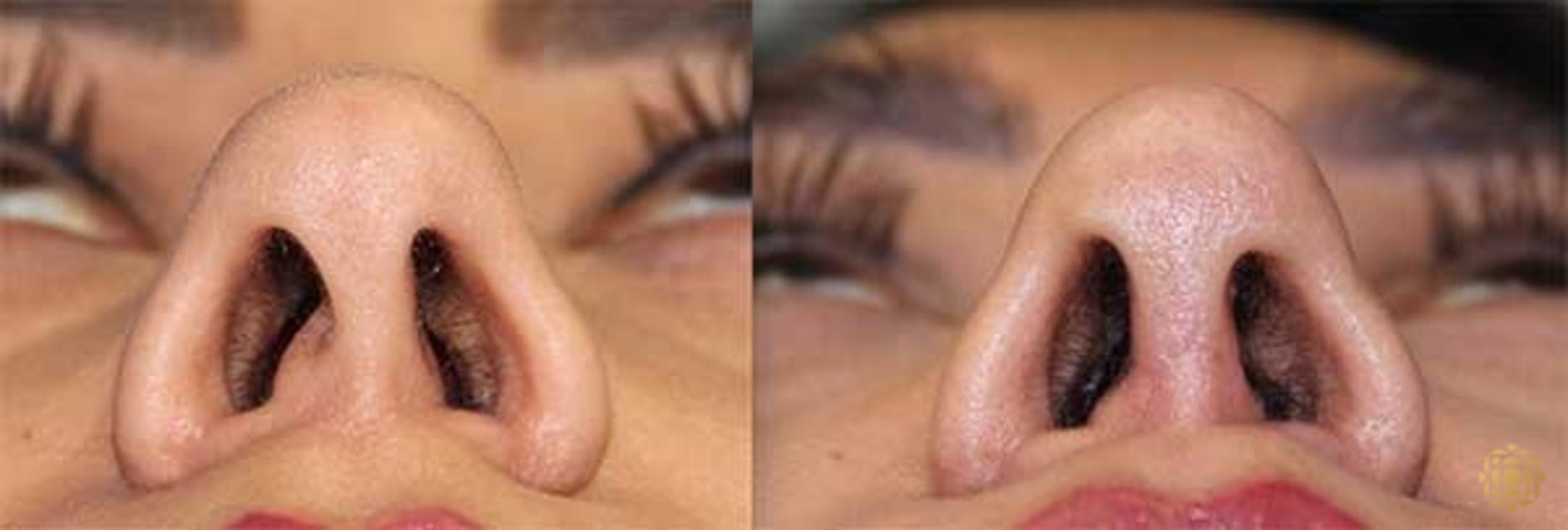 Before & After Rhinoplasty Case 143 Under View in Newport Beach, CA