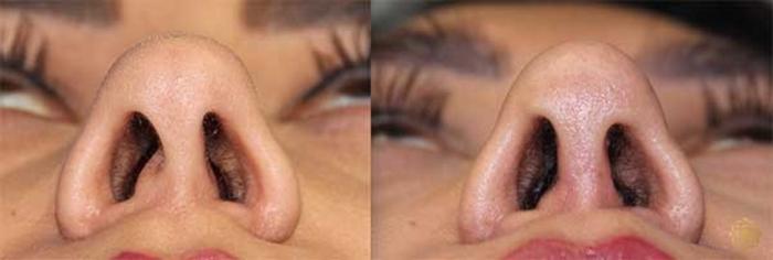 Before & After Rhinoplasty Case 143 Under View in Newport Beach, CA