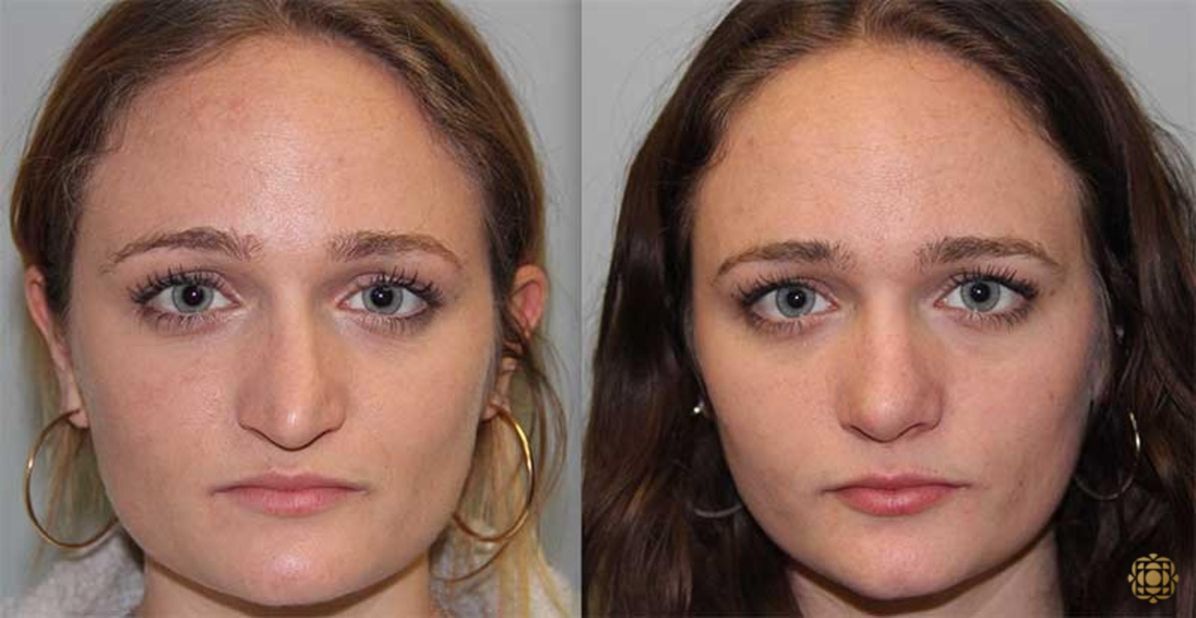 Before & After Rhinoplasty Case 149 View #1 View in Newport Beach, CA