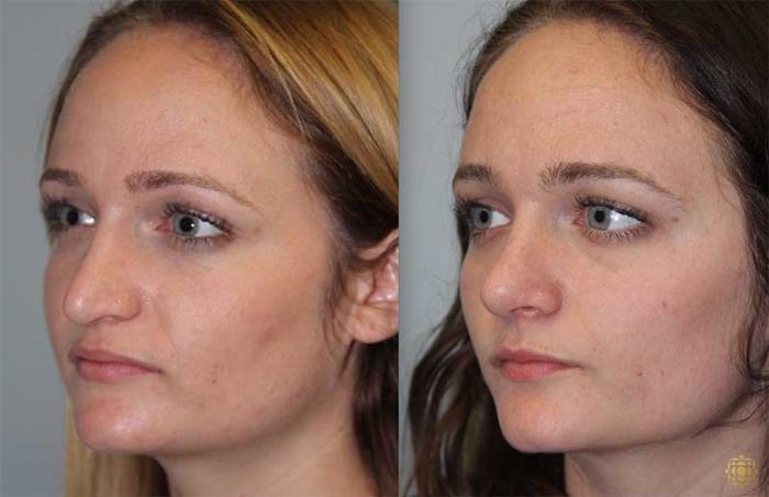 Before & After Rhinoplasty Case 149 View #2 View in Newport Beach, CA