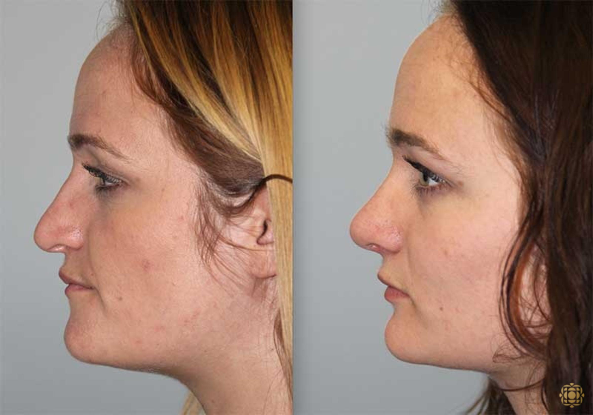 Before & After Rhinoplasty Case 149 View #3 View in Newport Beach, CA