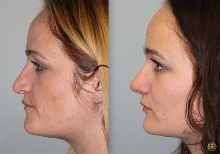 Before & After Rhinoplasty Case 149 View #3 View in Newport Beach, CA