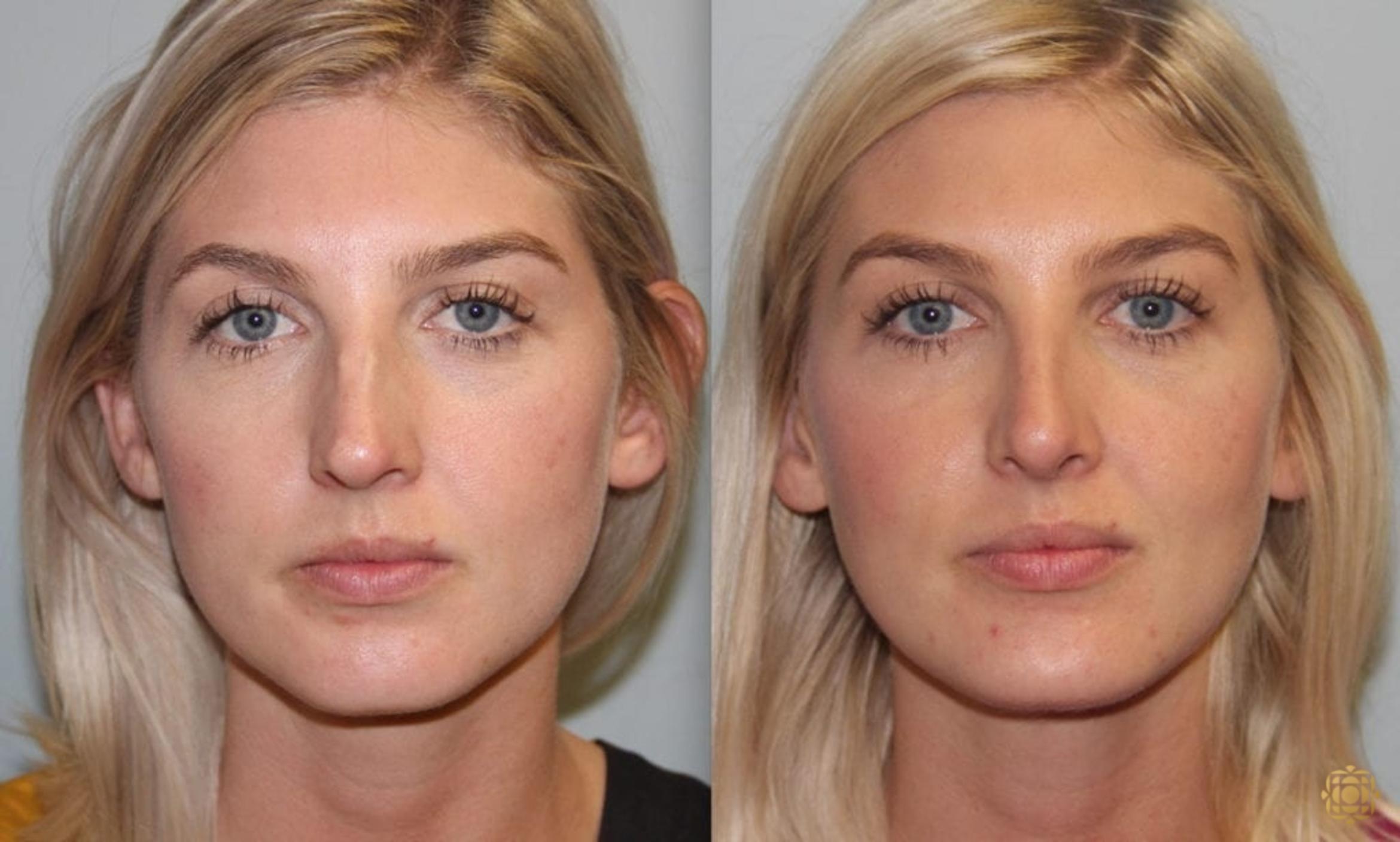 Before & After Rhinoplasty Case 150 Front View in Newport Beach, CA