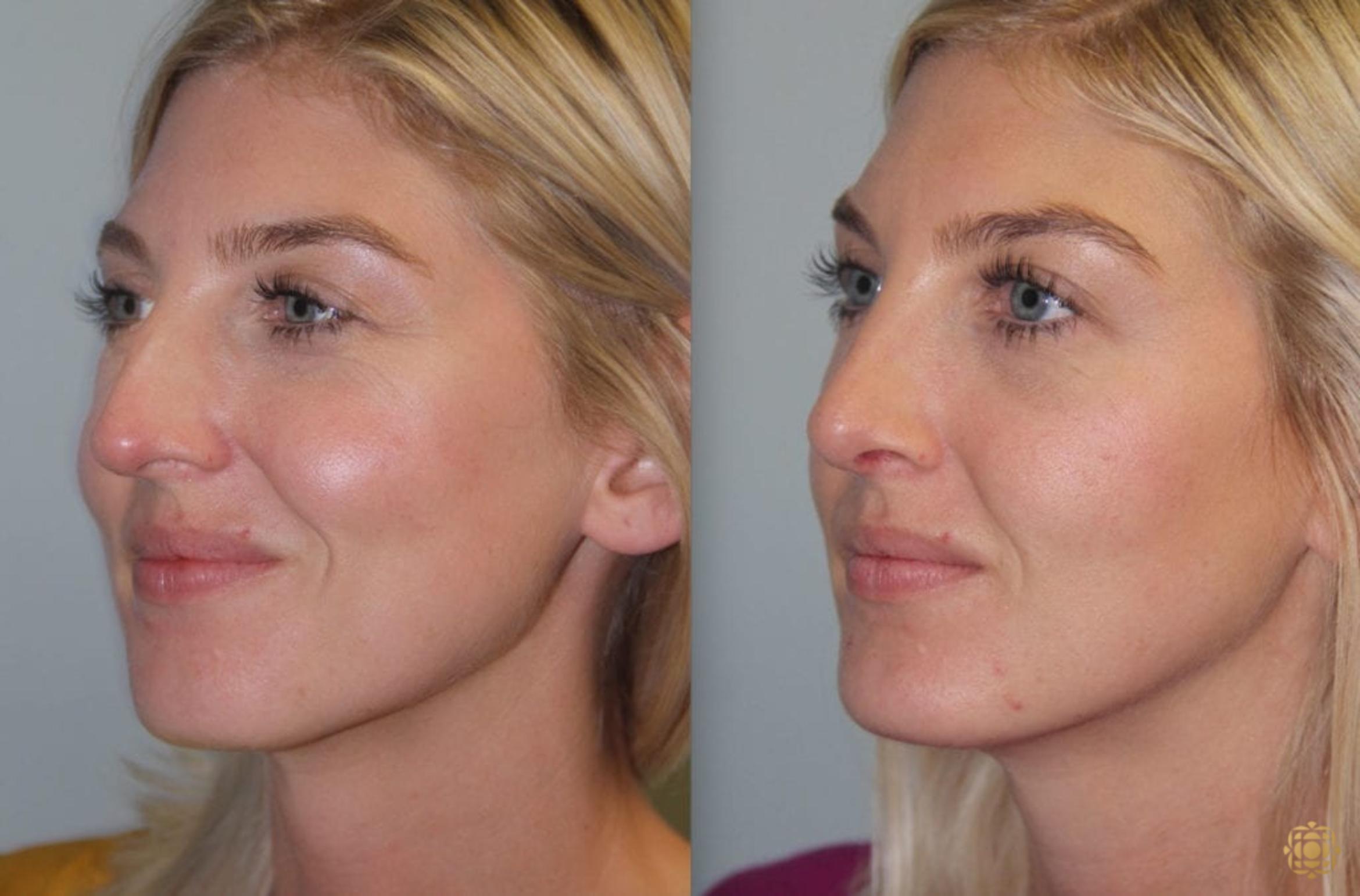 Before & After Rhinoplasty Case 150 Right Oblique View in Newport Beach, CA