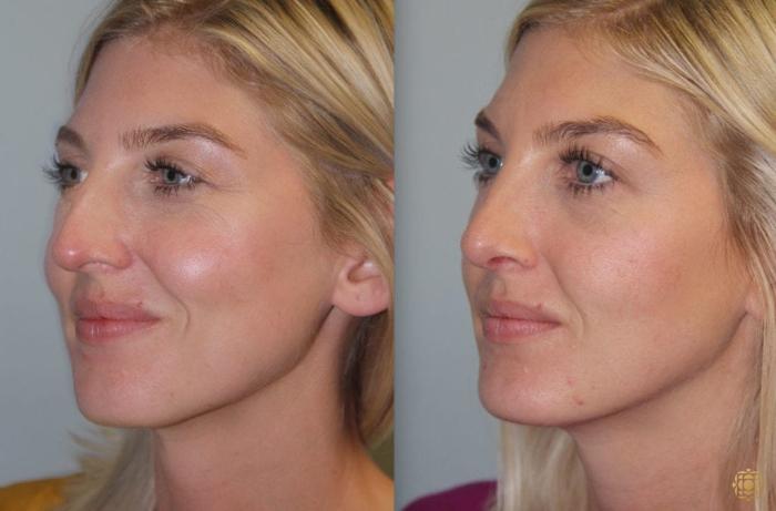 Before & After Rhinoplasty Case 150 Right Oblique View in Newport Beach, CA