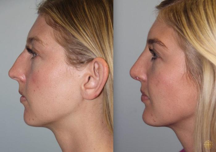 Before & After Rhinoplasty Case 150 Right Side View in Newport Beach, CA