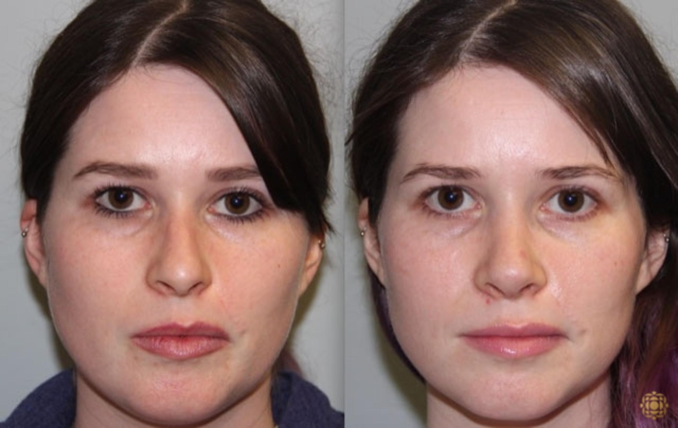 Before & After Rhinoplasty Case 157 Front View in Newport Beach, CA