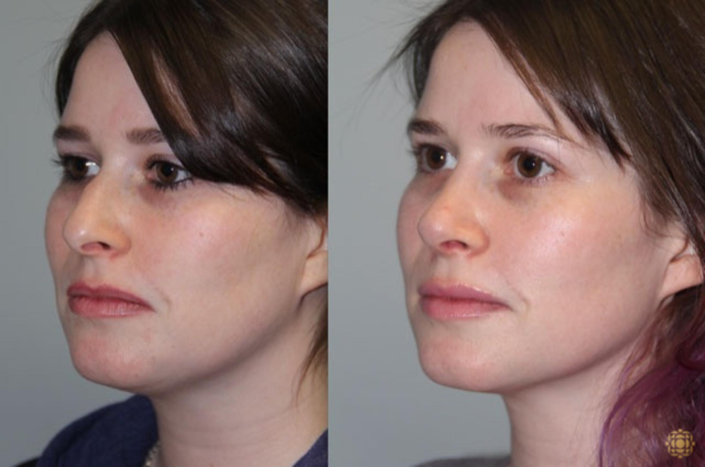 Before & After Rhinoplasty Case 157 Left Oblique View in Newport Beach, CA