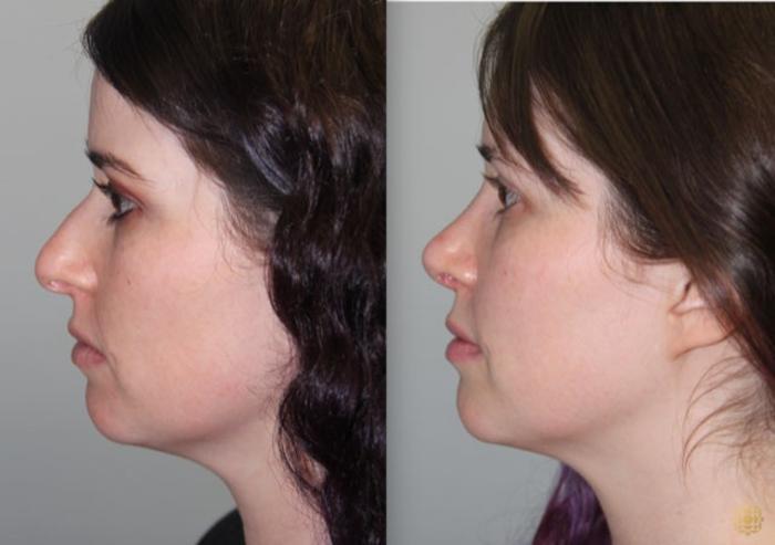 Before & After Rhinoplasty Case 157 Left Side View in Newport Beach, CA