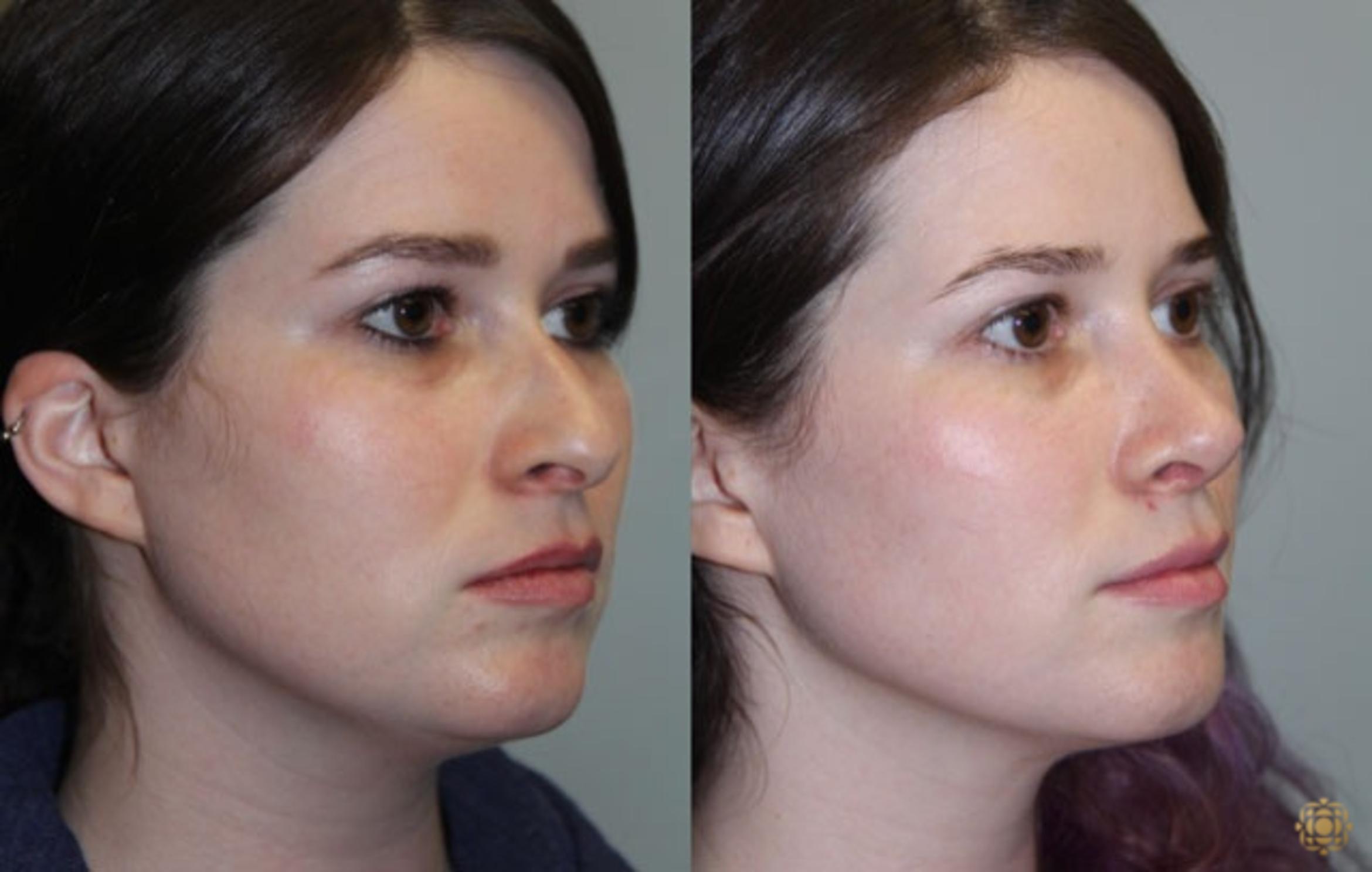Before & After Rhinoplasty Case 157 Right Oblique View in Newport Beach, CA