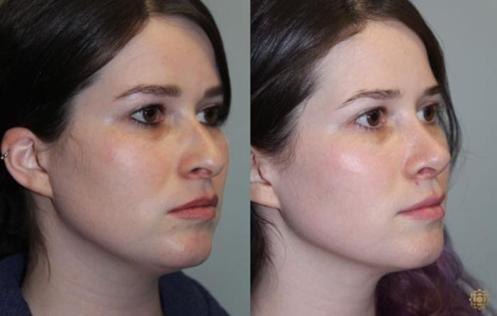 Before & After Rhinoplasty Case 157 Right Oblique View in Newport Beach, CA