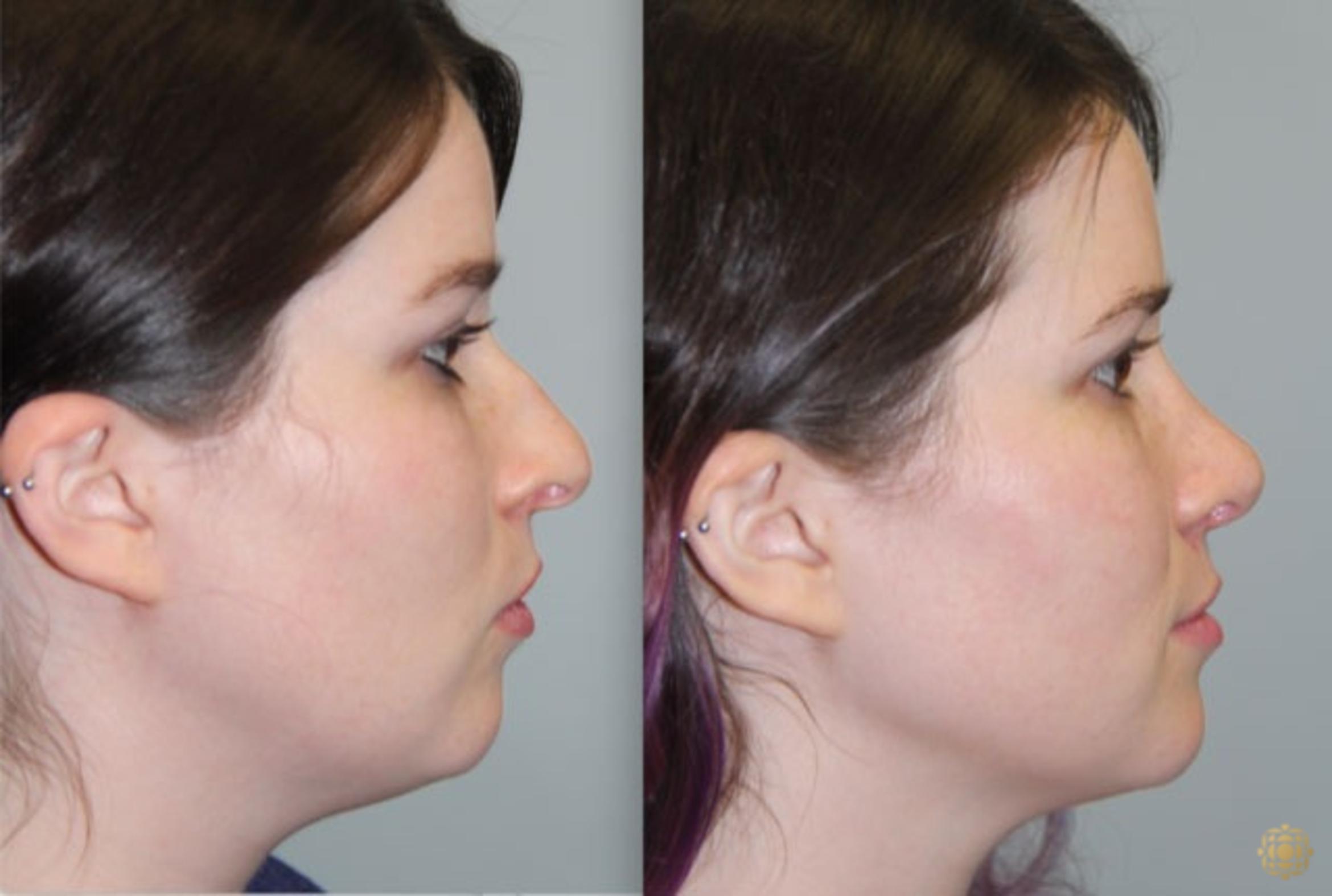 Before & After Rhinoplasty Case 157 Right Side View in Newport Beach, CA