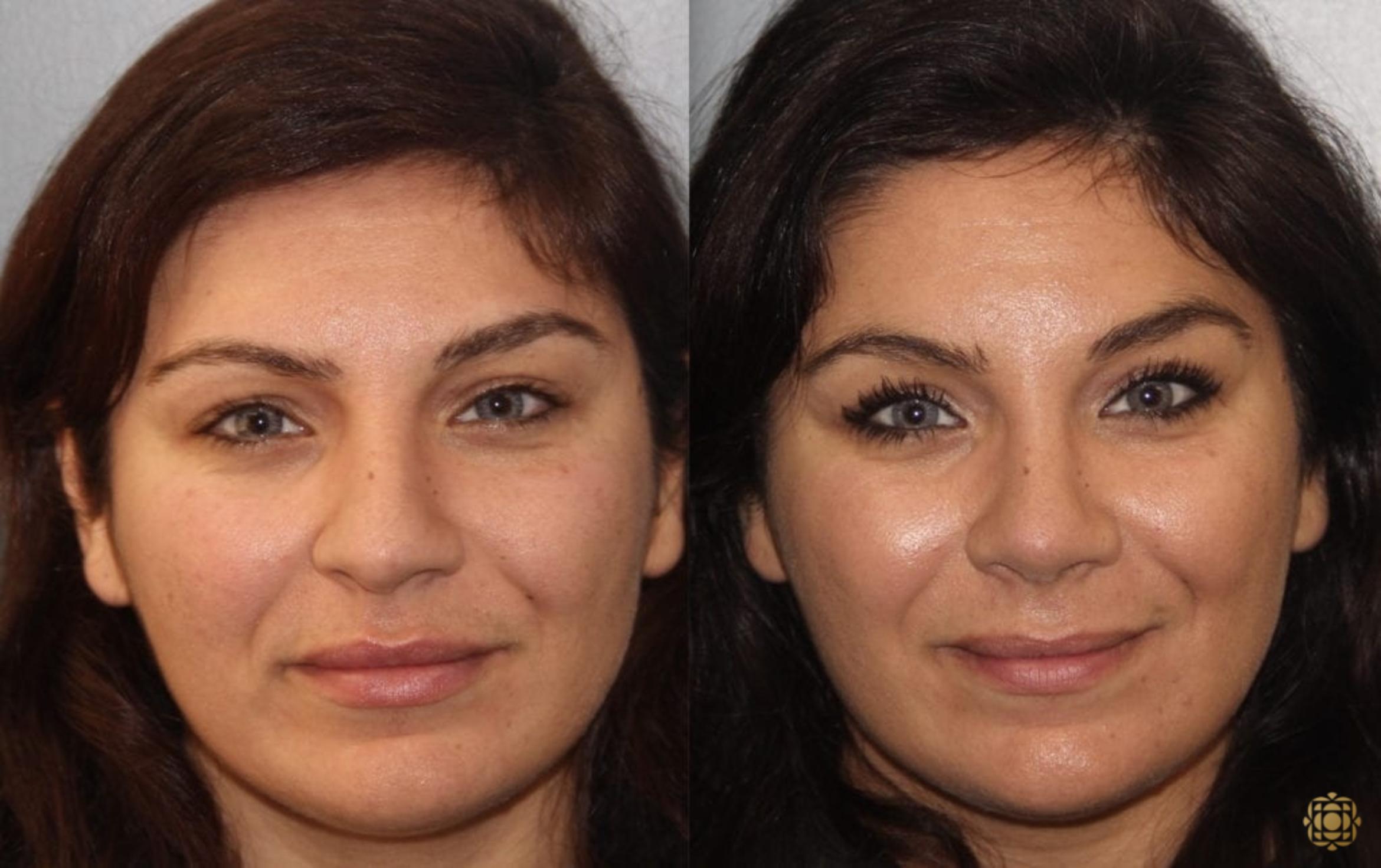 Before & After Rhinoplasty Case 158 Front View in Newport Beach, CA