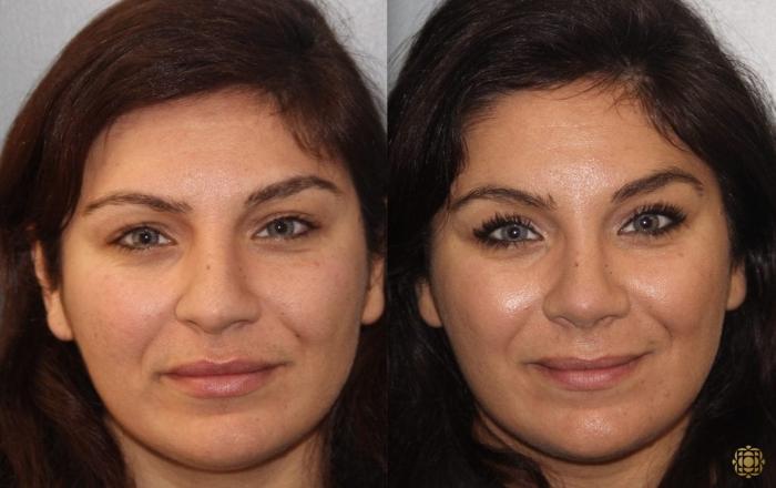 Before & After Rhinoplasty Case 158 Front View in Newport Beach, CA