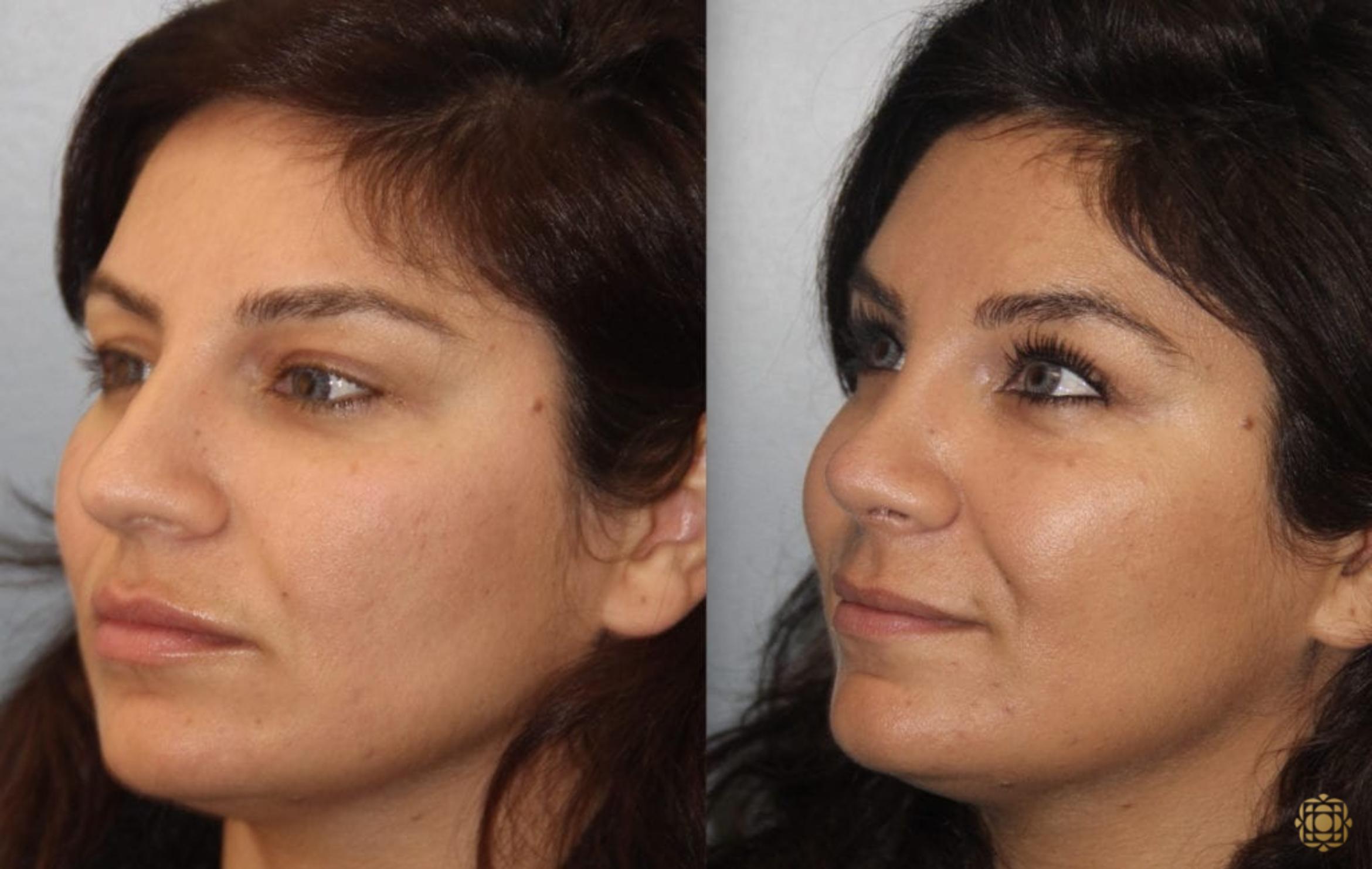 Before & After Rhinoplasty Case 158 Left Oblique View in Newport Beach, CA