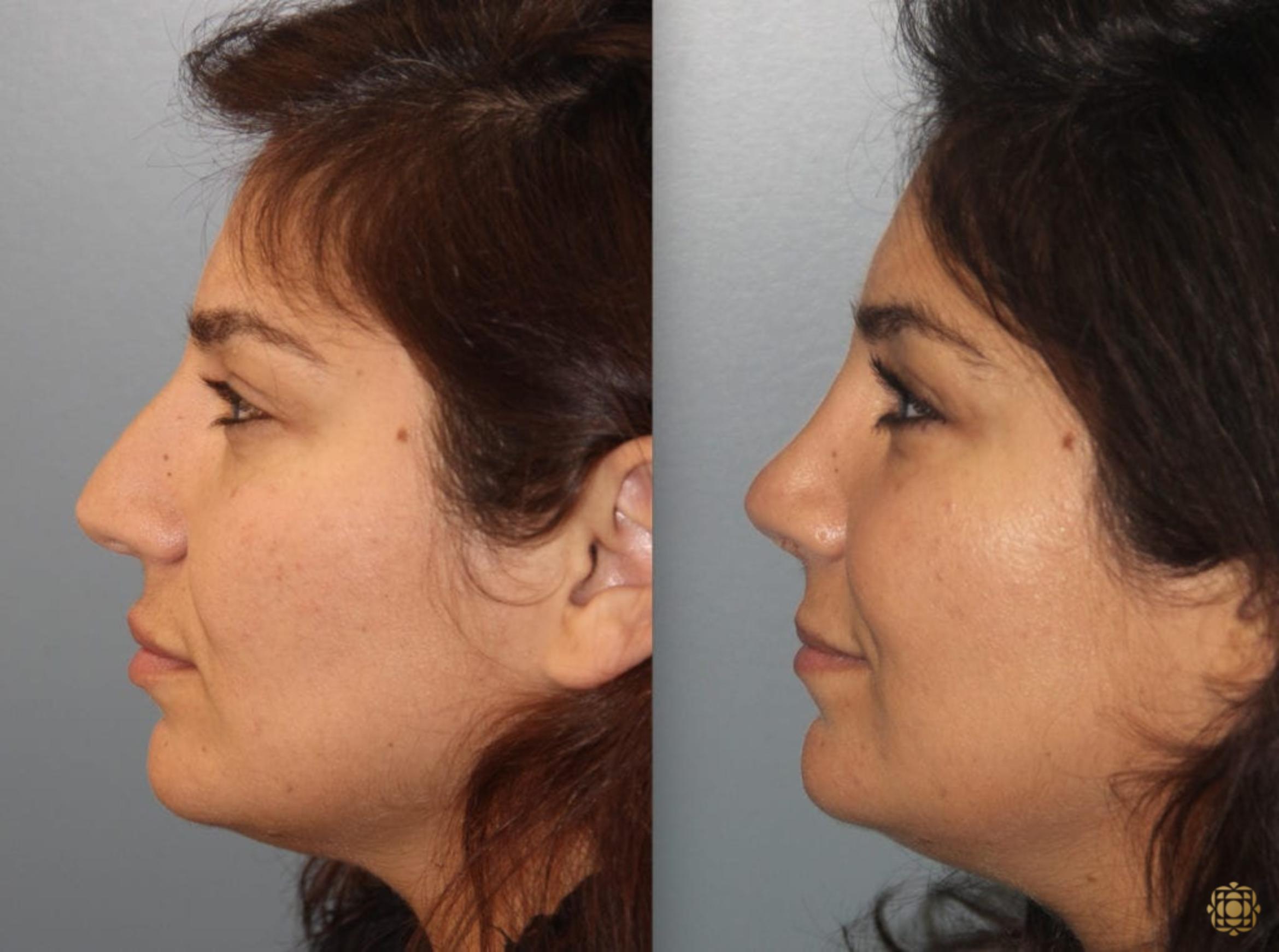 Before & After Rhinoplasty Case 158 Left Side View in Newport Beach, CA