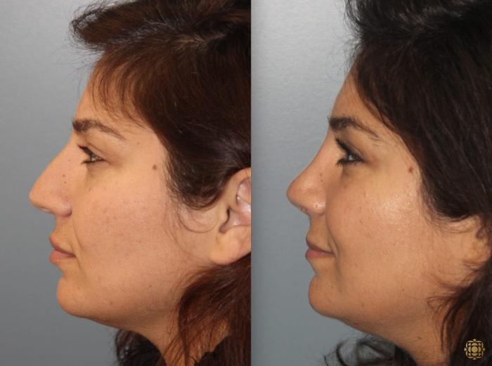 Before & After Rhinoplasty Case 158 Left Side View in Newport Beach, CA