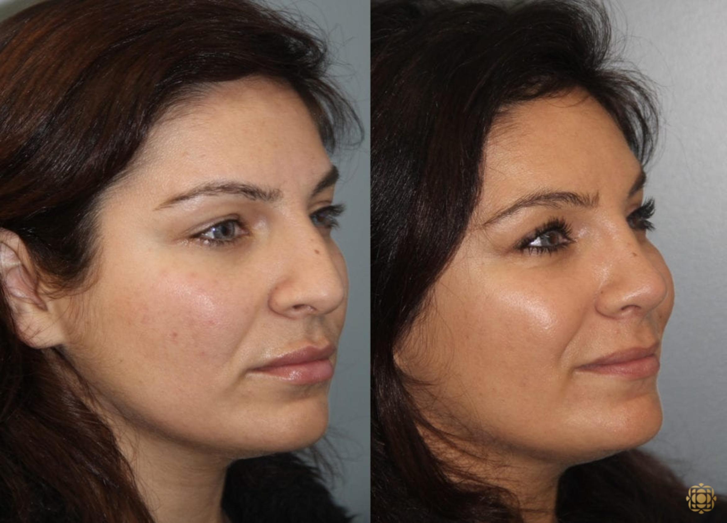 Before & After Rhinoplasty Case 158 Right Oblique View in Newport Beach, CA