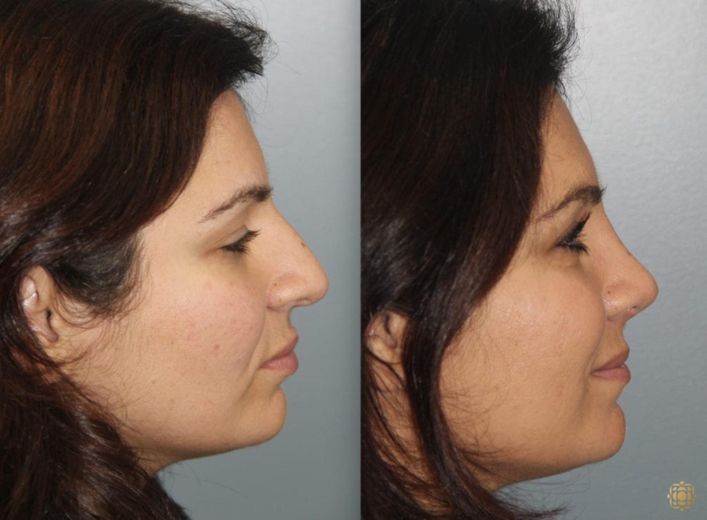 Before & After Rhinoplasty Case 158 Right Side View in Newport Beach, CA