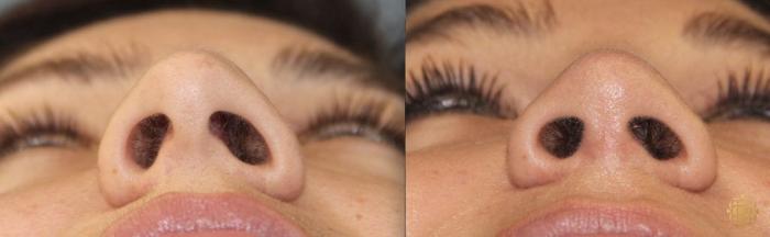 Before & After Rhinoplasty Case 158 Under View in Newport Beach, CA