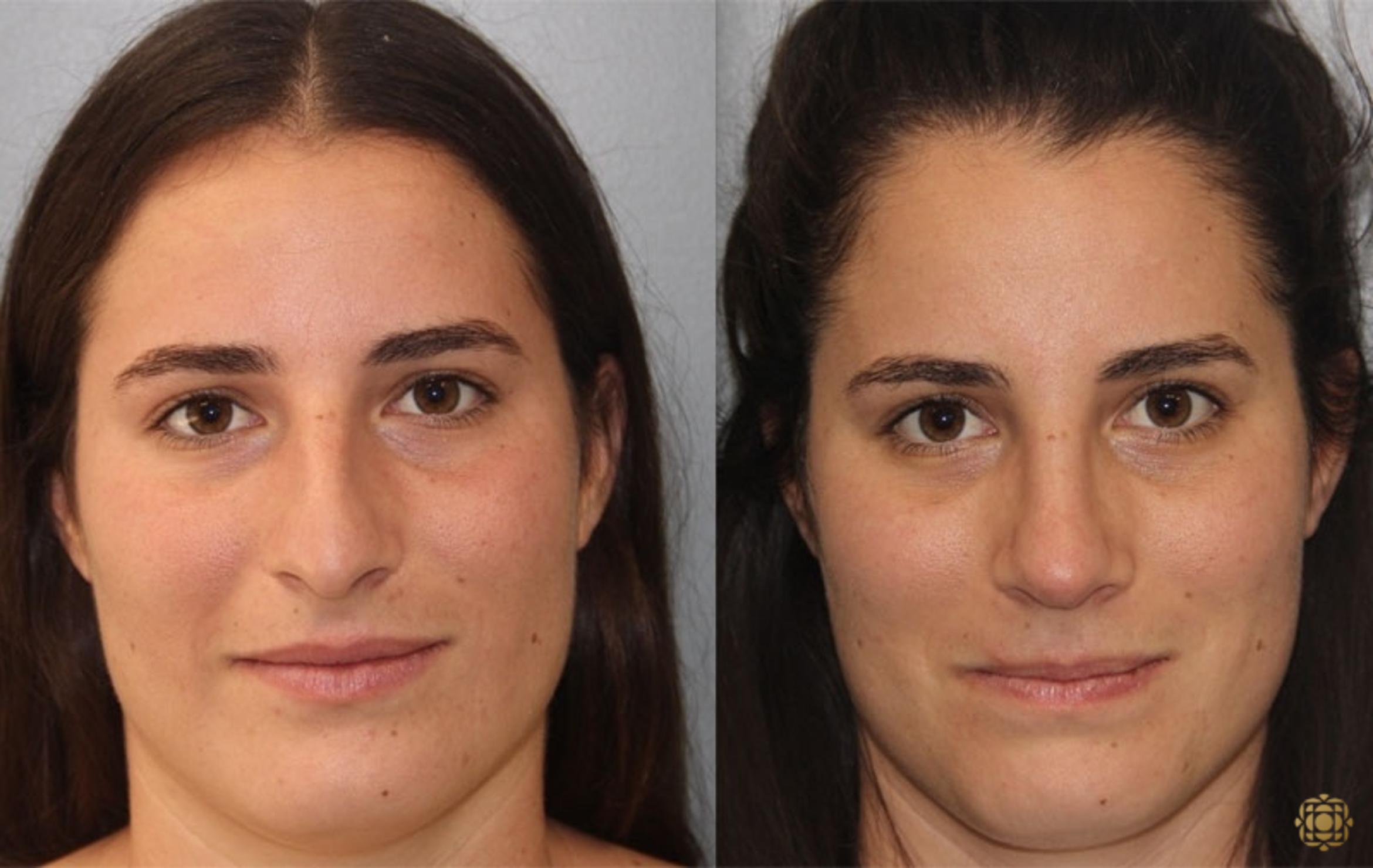 Before & After Rhinoplasty Case 168 Front View in Newport Beach, CA