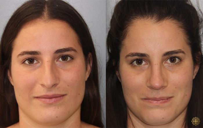 Before & After Rhinoplasty Case 168 Front View in Newport Beach, CA