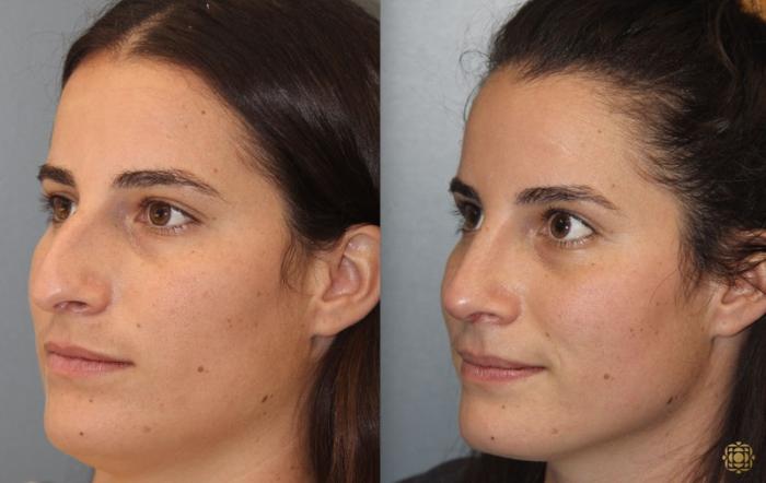 Before & After Rhinoplasty Case 168 Left Oblique View in Newport Beach, CA