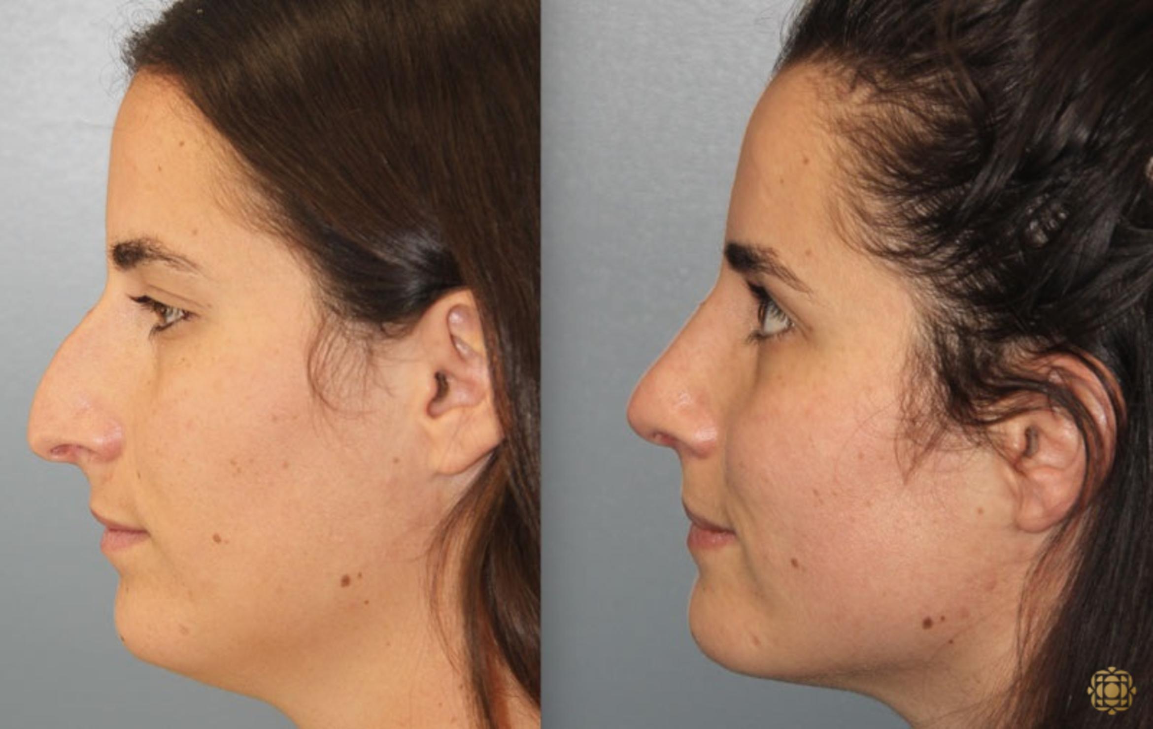 Before & After Rhinoplasty Case 168 Left Side View in Newport Beach, CA