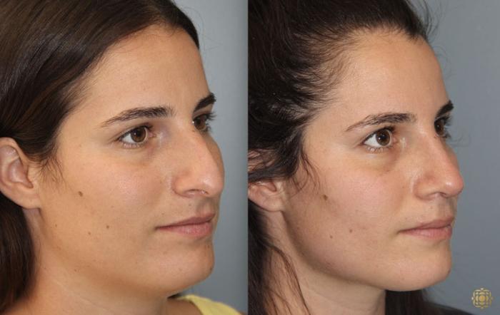 Before & After Rhinoplasty Case 168 Right Oblique View in Newport Beach, CA