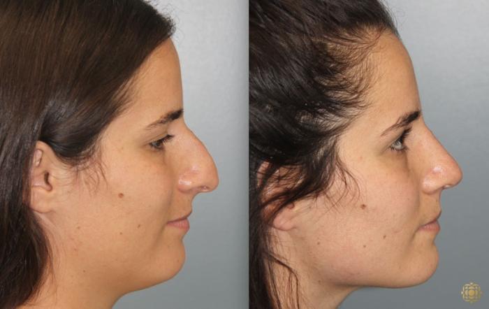 Before & After Rhinoplasty Case 168 Right Side View in Newport Beach, CA