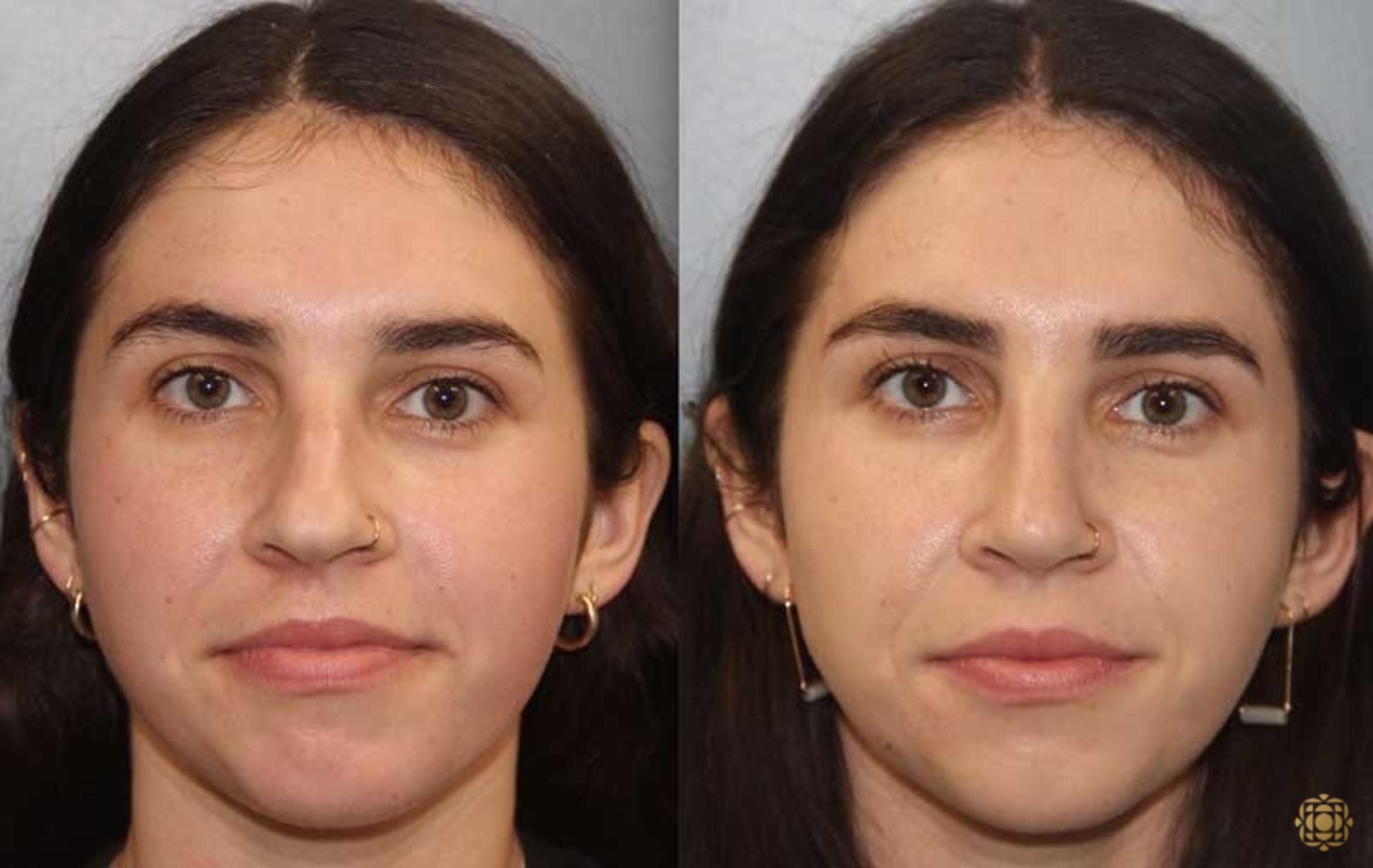 Before & After Rhinoplasty Case 174 Front View in Newport Beach, CA