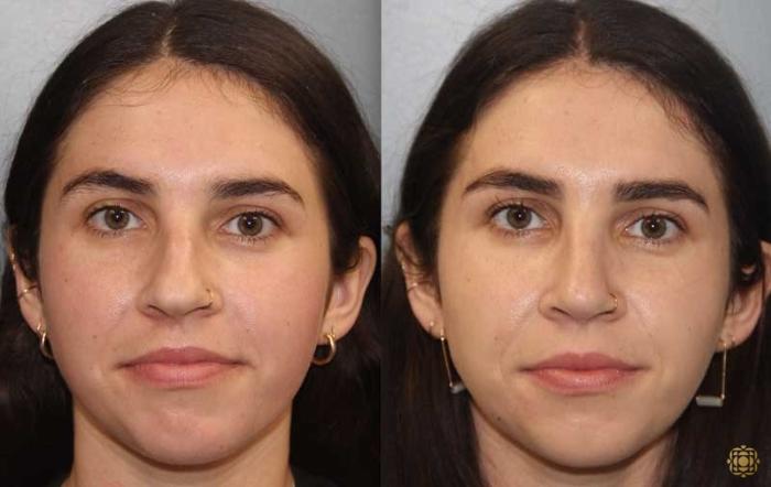 Before & After Rhinoplasty Case 174 Front View in Newport Beach, CA