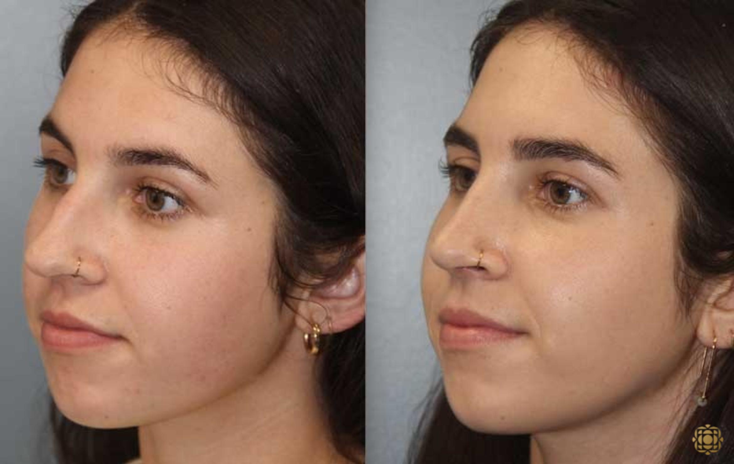 Before & After Rhinoplasty Case 174 Left Oblique View in Newport Beach, CA