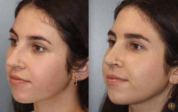 Before & After Rhinoplasty Case 174 Left Oblique View in Newport Beach, CA
